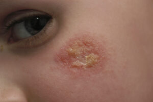someone suffering from eczema
